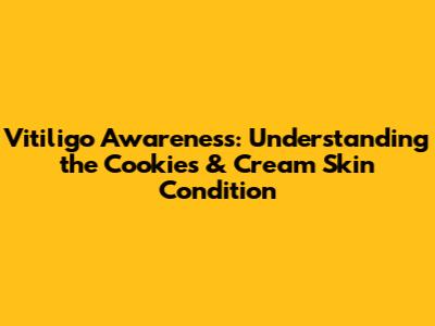 Vitiligo Awareness: Understanding the Cookies & Cream Skin Condition